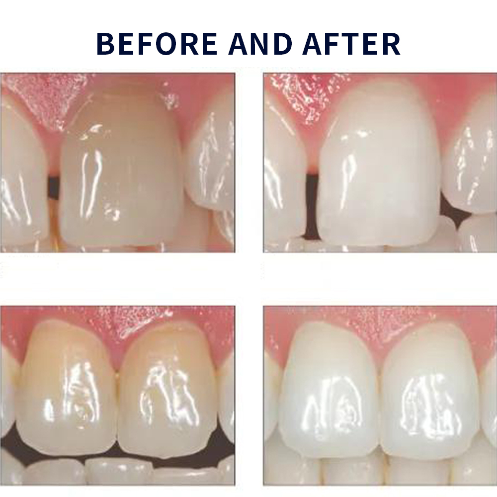 Opalescence Whitening 20% PF 2 - Teeth Whitening Remedies reseña y precio