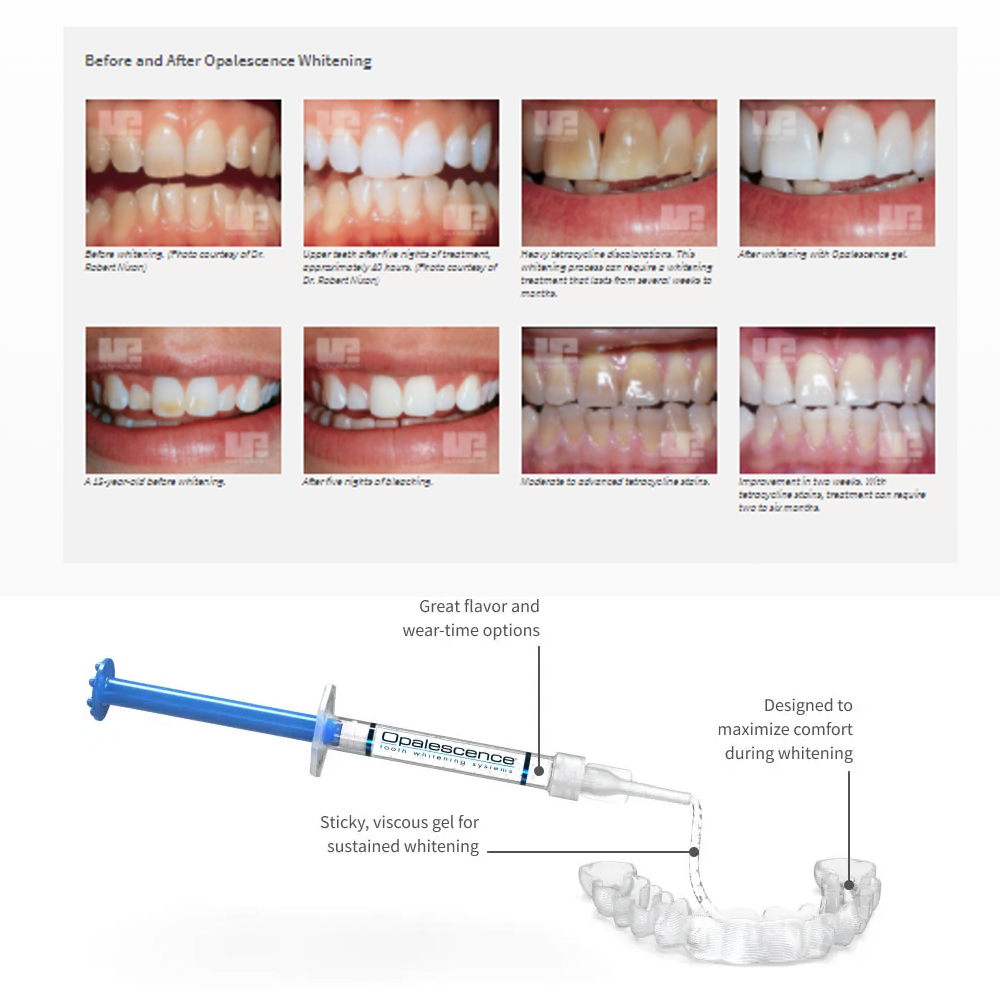 Opalescence Whitening 20% PF 2 - Teeth Whitening Remedies reseña y precio