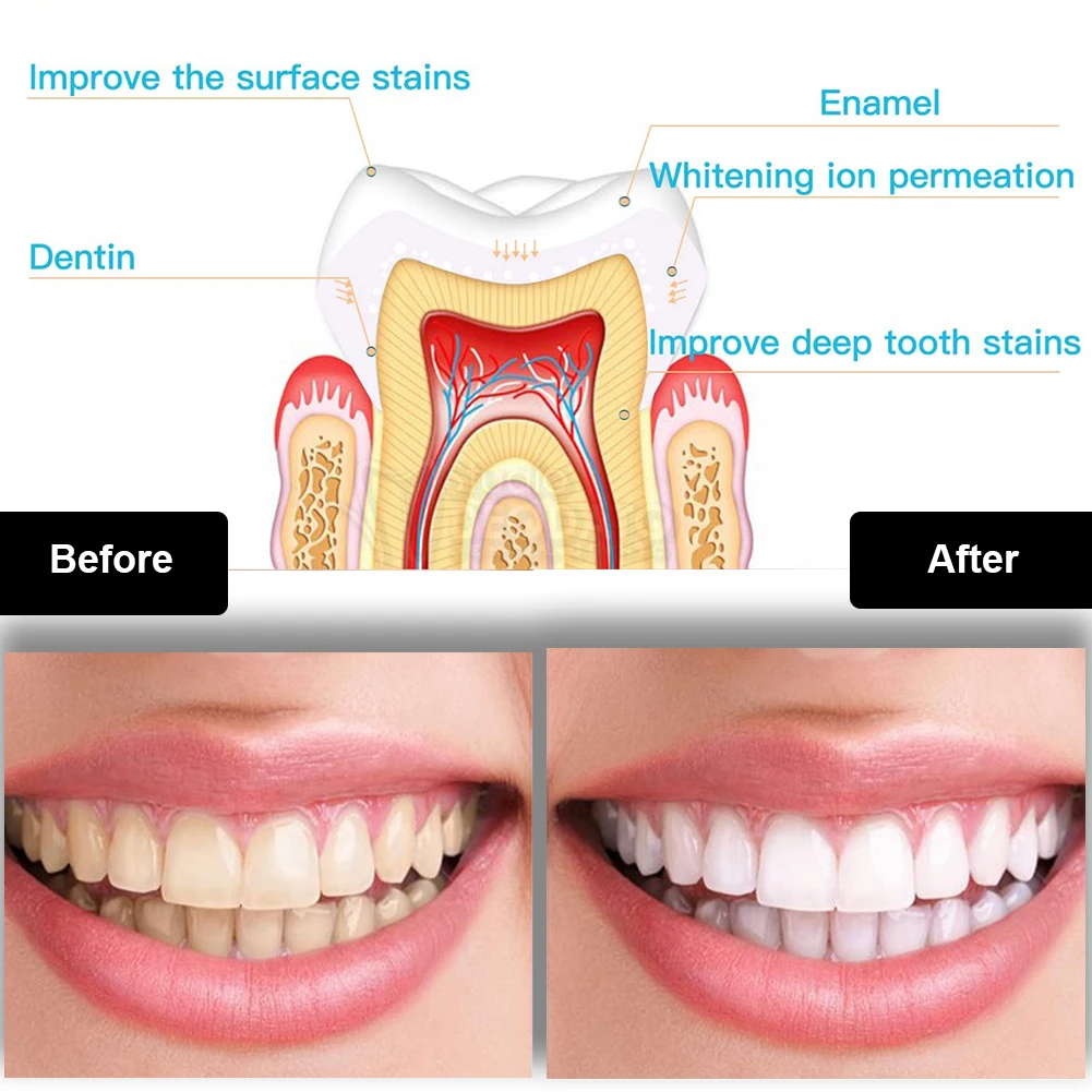 Dental Teeth Whitening Kit Min - Teeth Whitening Remedies reseña y precio